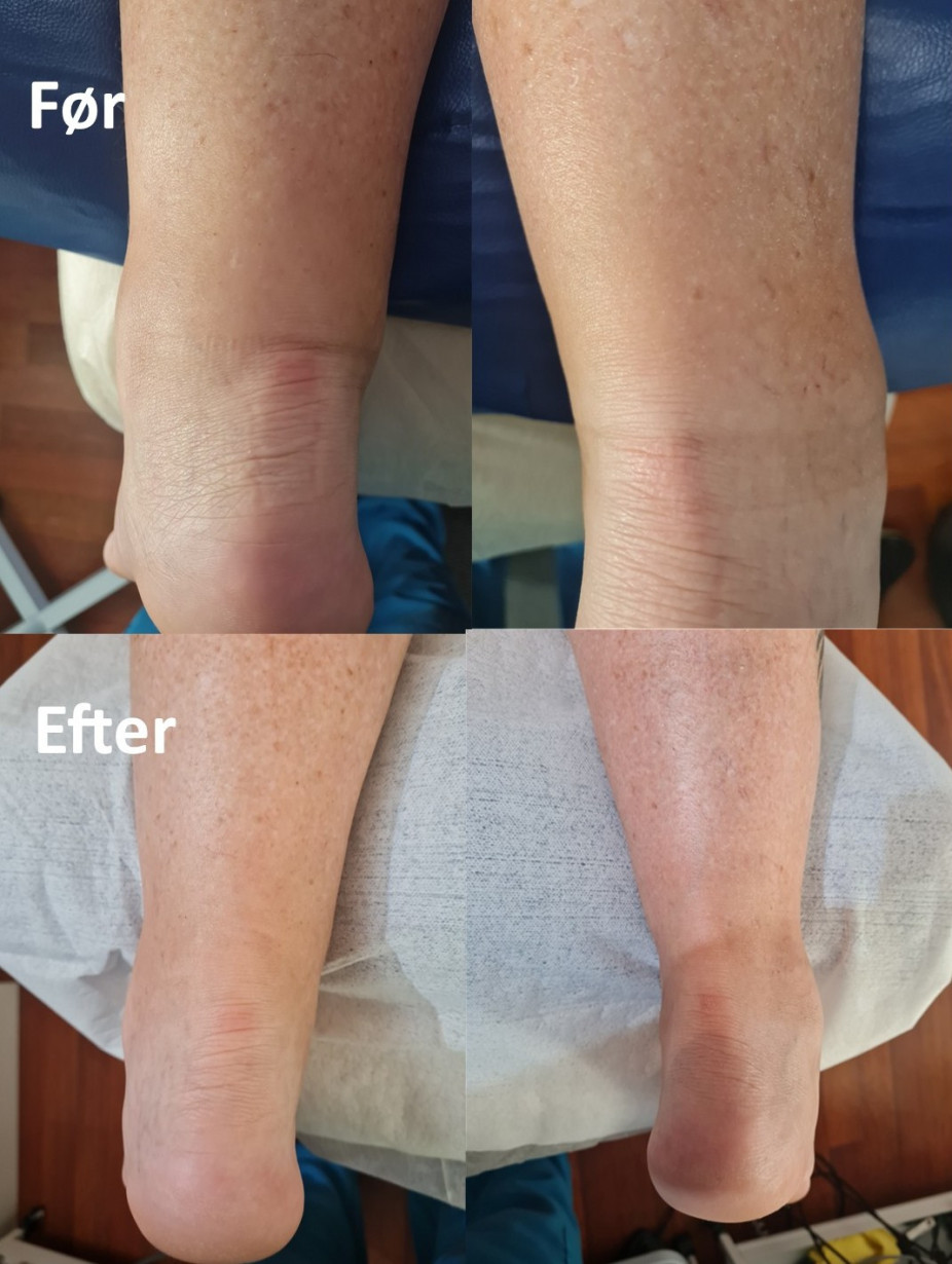 Gendan din mobilitet og lethed i benene med vores specialiserede behandling.