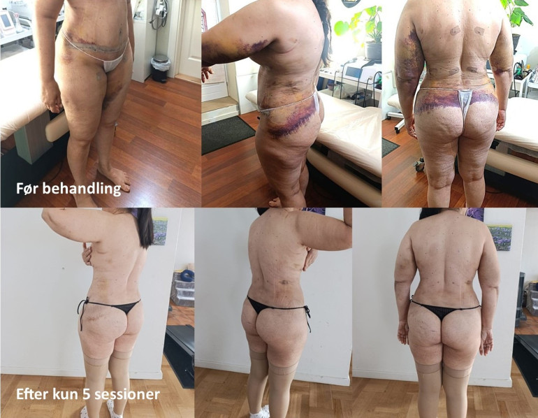 Lymfedrænage Hillerød AntonioShiatsu: Reduktion af hævelse og blå mærker efter kun 5 behandlinger.